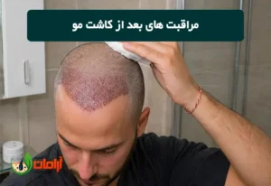 مراقبت های بعد از کاشت مو