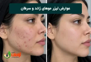 عوارض لیزر موهای زائد و سرطان